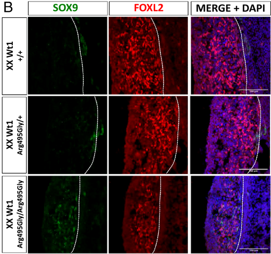 由基因突变导致的WT1蛋白ZF4锌指结构异常，降低FOXL2蛋白表达（促进卵巢发育），但会增强SOX9蛋白表达（促进睾丸发育）。