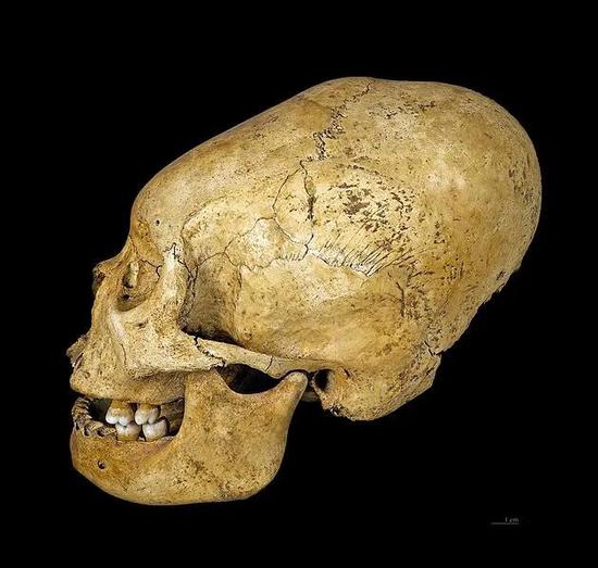 秘鲁纳斯卡区出土的变形头骨 | Didier Descouens / Wikimedia Commons