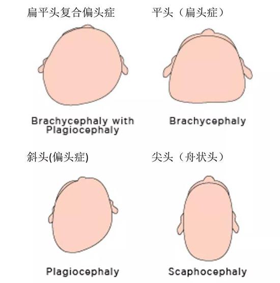 四种不同类型的扁头综合症