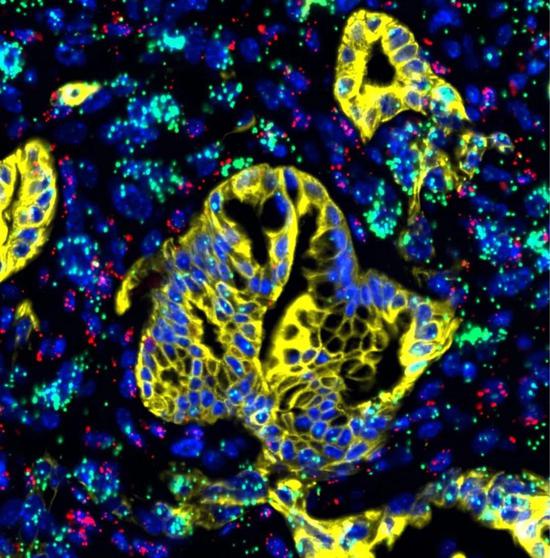  ▲在胰腺癌组织中，研究人员们观察到了大量LIF蛋白（绿色）。图中黄色为癌细胞（图片来源：Salk Institute）