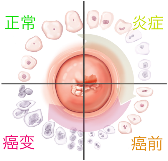 图4。 子宫颈病变过程及细胞形态变化（来源：biology-forums.com）