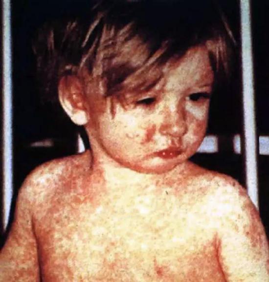 麻疹为一种主要好发于儿童身上的传染病。图片来源：wikimedia