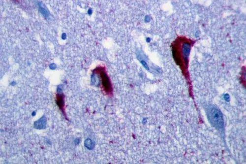 ▲AD患者海马区的神经元中出现神经原纤维缠结（图片来源：参考资料[2]）