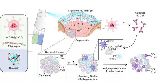 ▲喷雾凝胶示意图：包埋在纤维蛋白胶里的碳酸钙纳米颗粒缓释出的抗体可以封闭癌细胞表面表达的CD47（图片来源：参考资料[1]）