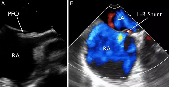 曹操为什么总是头痛？（不是高血压）