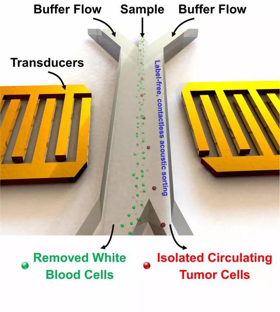 利用声镊技术可以分离血细胞和肿瘤细胞。图片来源：Tony Jun Huang， PhD， Pennsylvania State University