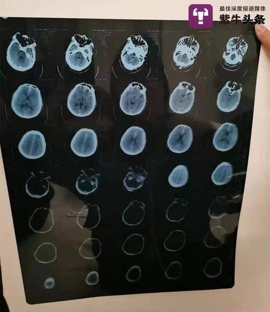 王先生入院后拍的CT