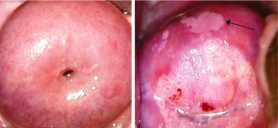 图 6。 左图为正常的子宫颈；右图为感染并病变的子宫颈，箭头指示醋酸处理后变白的区域（来源：WHO）