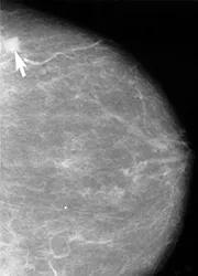 乳腺X线可以发现小癌灶，这项技术大大改善了乳腺癌的早期发现（图片来源：NIBIB）