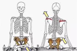 二郎腿导致的骨盆位置改变