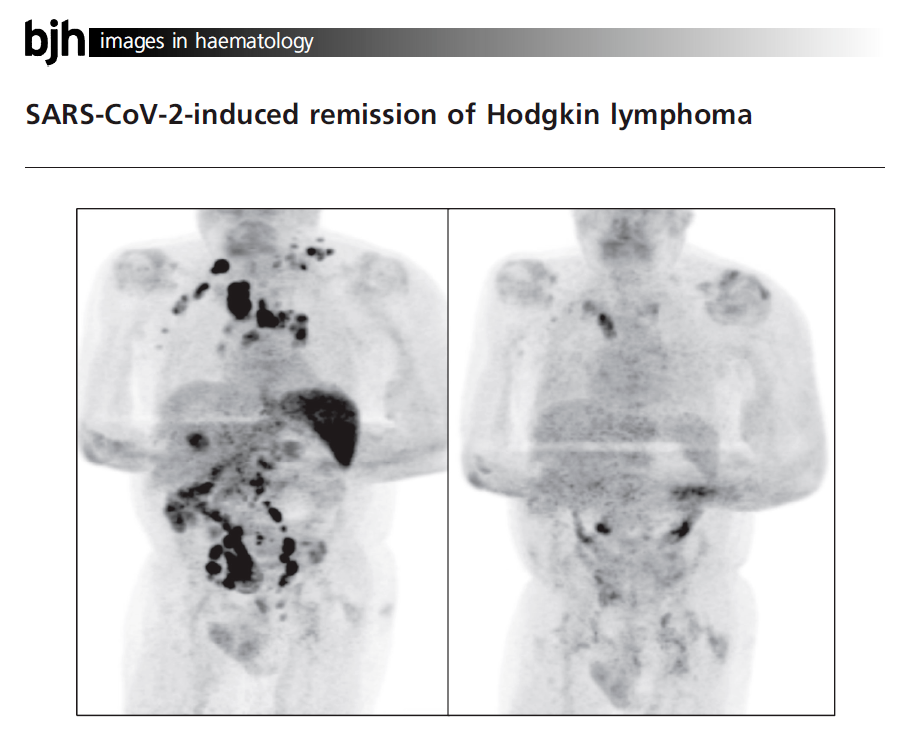 一名肿瘤患者感染新冠之前（左）和感染恢复后（右）的PET/CT扫描结果，图源：British journal of haematology