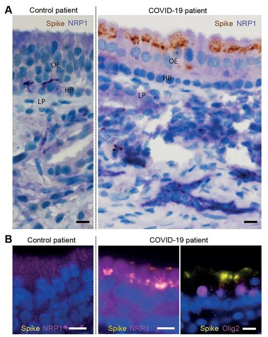 患者的鼻腔样本组织显示，新冠病毒感染了NRP1阳性的嗅上皮细胞