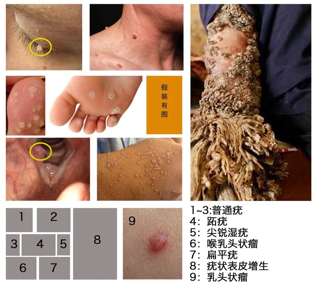 hpv感染的皮肤病图片图片