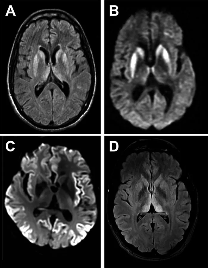 ▲克雅病会造成大脑的严重损伤（图片来源：Pract Neurol [CC BY 4.0 （https：//creativecommons.org/licenses/by/4.0）]， via Wikimedia Commons）