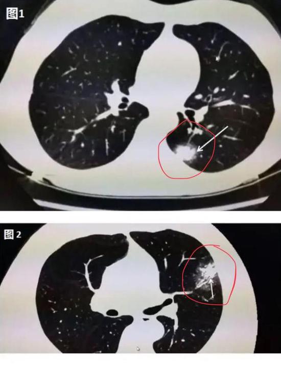 ▲图1：肺部CT上出现一白色的小斑片； 　　▲图2：中央区域是一白色的小斑片，周围则像云雾状磨砂玻璃一样（图片来自网络）