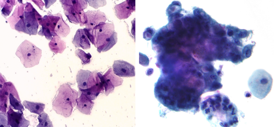 图7。 左图，正常的子宫颈鳞状上皮细胞，细胞扁平，大小、形状均一，细胞核固缩且仅有一个（每个细胞内部的深色小点）；右图，癌变的子宫颈细胞，癌细胞聚集成团，形状已经发生变化，细胞核相对比较大，或者有多个细胞核。（来源：维基百科）