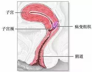 宫颈癌病变示意图