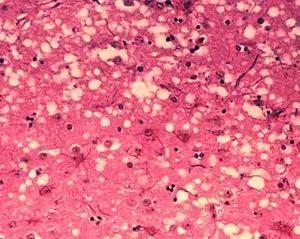 被朊毒体感染的脑组织产生了海绵状空洞 图片来源：wikipedia