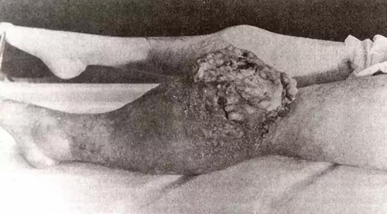 四乙基铅:这位孤独先知能查明每种毒物仍无法阻止美国人作死 这位镭姑娘癌变的是膝盖