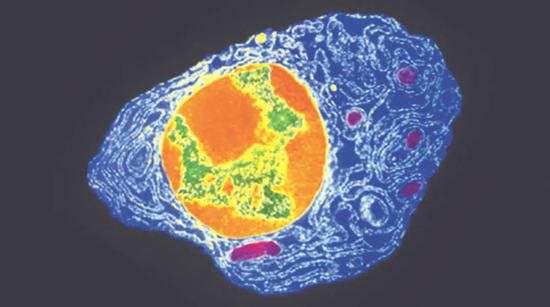 骨髓浆细胞图像。图片来源：GOPAL MURTISCIENCE SOURCE
