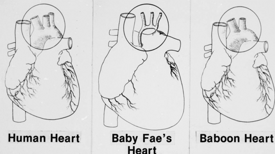 正常人类心脏，史蒂芬妮的心脏，狒狒的心脏对比图