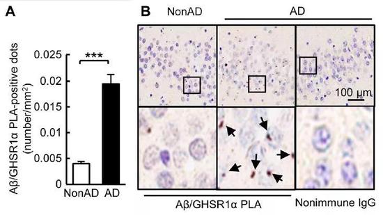  ▲在AD患者的大脑海马体中，淀粉样蛋白沉积与饥饿素受体结合（图片来源：参考资料[1]）