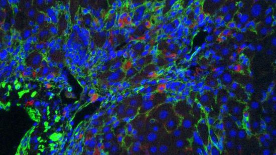 ▲绿色的CAR-T细胞正在攻击红色的衰老细胞（图片来源：Memorial Sloan Kettering Cancer Center）