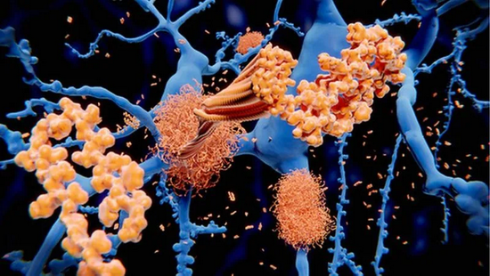 淀粉样蛋白在突触附近积聚，影响细胞间交流，导致阿尔茨海默症。|SCIENCE PHOTO LIBRARY