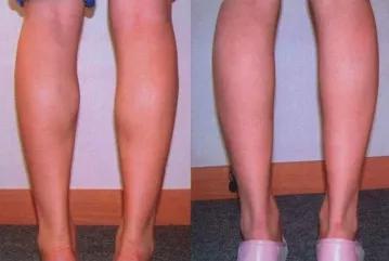 小腿肌肉阻断术后（右）小腿下部明显凸出来源丨《胫神经腓肠肌肌支神经切断术缩减小腿体积的基础与临床研究》