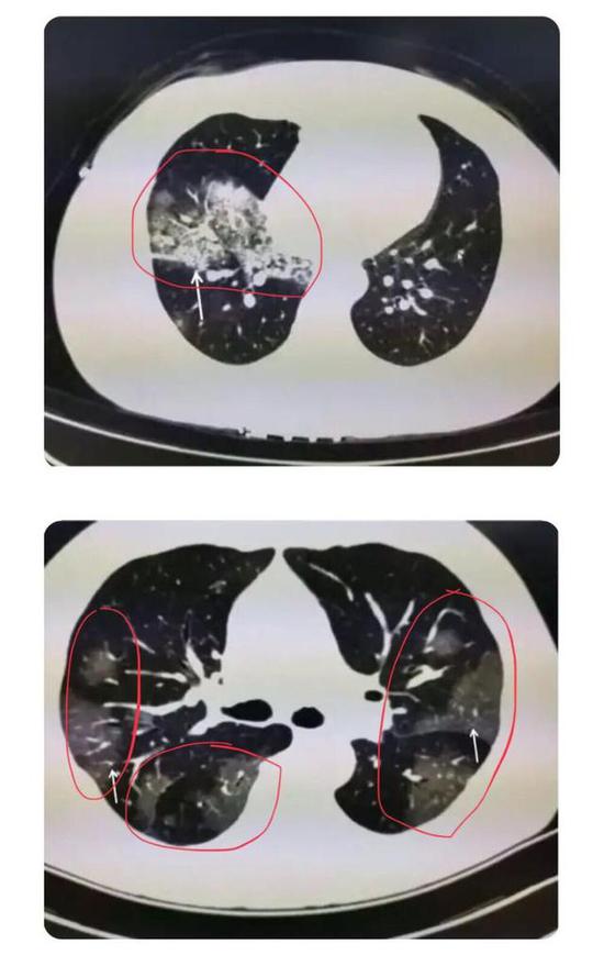 ▲上面的图：单侧肺出现磨玻璃影，累及一个肺叶； 　　▲下面的图：双侧肺均出现磨玻璃影，累及多个肺叶（图片来自网络）