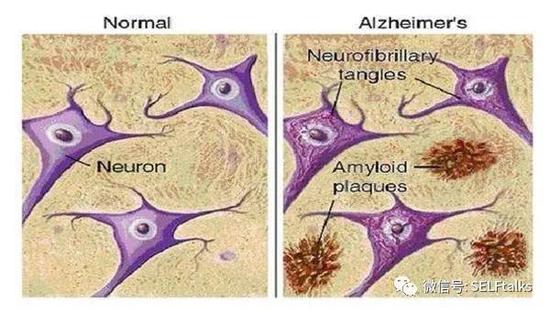 神经纤维缠结和Aβ蛋白的沉积