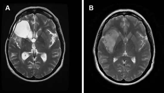 曹操为什么总是头痛？（不是高血压）