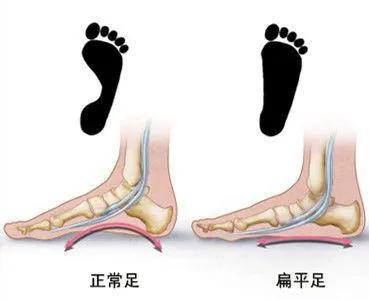 足弓塌陷来源丨网络