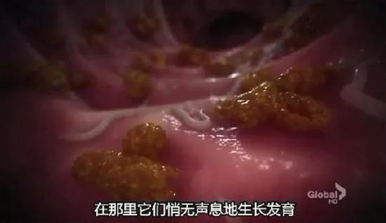 感染期蛔虫卵在人体小肠中孵出幼虫。剧照的展现还挺写实的,受精的蛔虫卵宽椭圆形,通常会被宿主的胆汁染黄。卵壳外常有一层由蛔虫子宫分泌物形成的凹凸不平的蛋白质膜,卵壳厚而透明。图片来源:《豪斯医生》剧照
