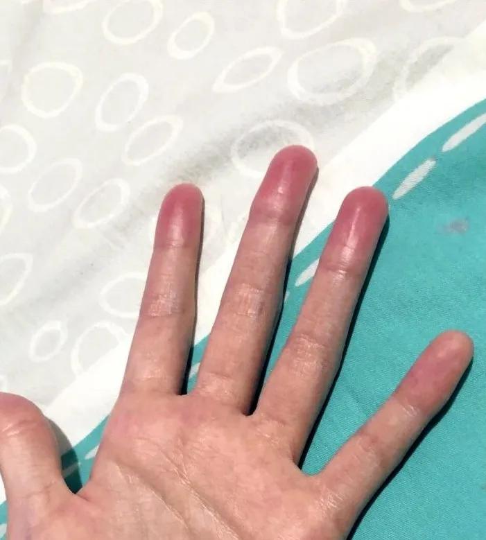一名女孩在玩史莱姆后出现手指红肿的情况