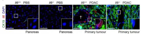 胰腺癌胁迫周围正常细胞分泌IL-6