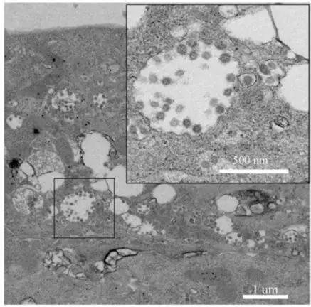  图4。 2019-nCoV在细胞内的电镜观察。