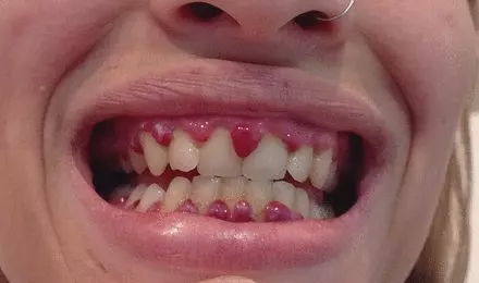 这个22岁的女患者因为厌食症而长期缺乏维生素C，她最终出现了牙龈萎缩充血、下肢淤肿的坏血病表现。图片来源：dx.doi.org/10.1136/bcr-2017-223686