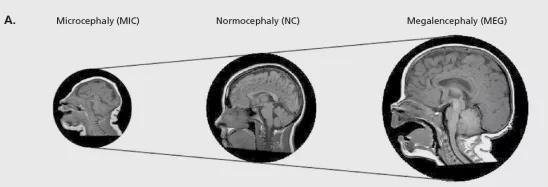 三种不同的脑尺寸MRI对比  图源：doi：10.31887/DCNS.2018.20.4/gmirzaa