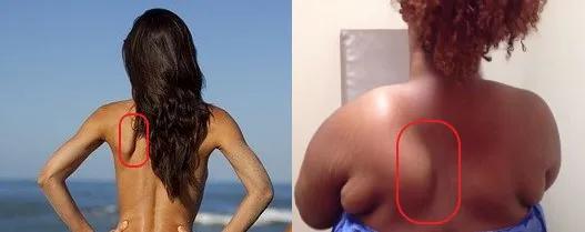 呼之欲出的“蝴蝶骨”不是瘦人专属，只要够突出，胖人也会拥有 | pixabay/orthobullets