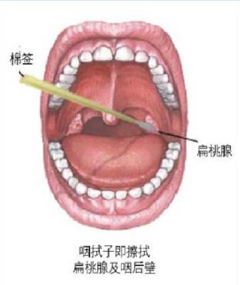 核酸检测插喉示范图图片