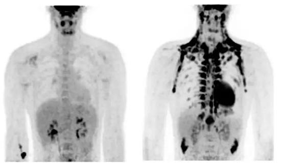 温度不低时棕色脂肪代谢（肩颈黑色区域）不大（左），受寒后体内棕色脂肪的代谢显著增加（右）