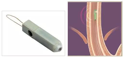左图是上消化道pH胶囊内窥镜，右图是其固定在食管臂上的示意图，通过无线通讯的方式将持续采集到的pH值发送至体外。