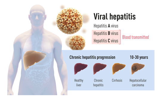 　图1：肝炎有两种主要形式。第一种是由甲型肝炎病毒（Hepatitis A virus）引起的急性疾病，这种病毒由受污染的水或食物传播。另一种由乙型肝炎病毒（Hepatitis B virus）或丙型肝炎病毒（Hepatitis C virus）引起（即今年的诺贝尔奖表彰的贡献），这种形式的血源性肝炎通常是一种慢性疾病，可能会发展为肝硬化和肝细胞癌。