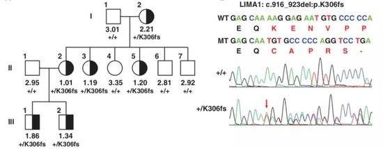 图5 LIMA1基因的突变LIMA1-K306fs和血浆低LDL-c水平有关[6]