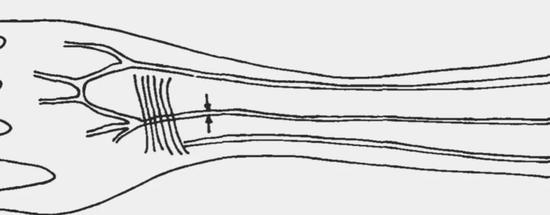 正中动脉在前臂中的位置（箭头处）。来源：Maciej Henneberg