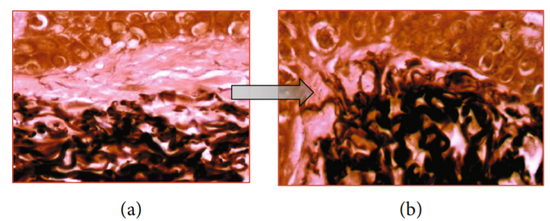 组织染色提示应用 ADSC 后皮肤内纤维蛋白含量的增多