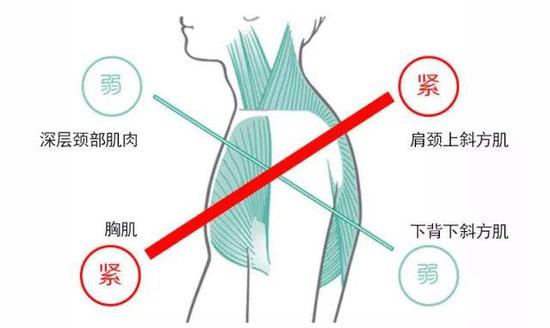 ▲上交叉综合症受影响肌肉分布图