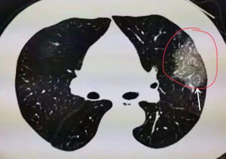  ▲新冠肺炎患者肺部CT显示磨玻璃影（图片来自网络）