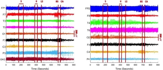 左为左脑神经活动情况，右为右脑神经活动情况。S（seizure）=癫痫发作，LS（left-sided suppression）=左脑抑制，BS（bilateral suppression）=左右脑都抑制，CA（cardiac arrest）=心脏骤停
